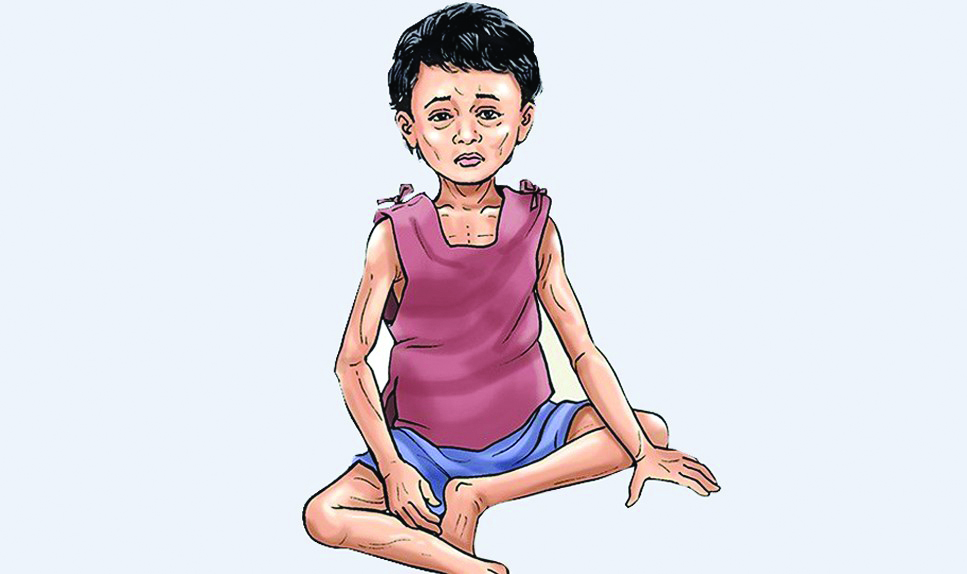 बाँकेका बालबालिकामा कडा कुपोषण